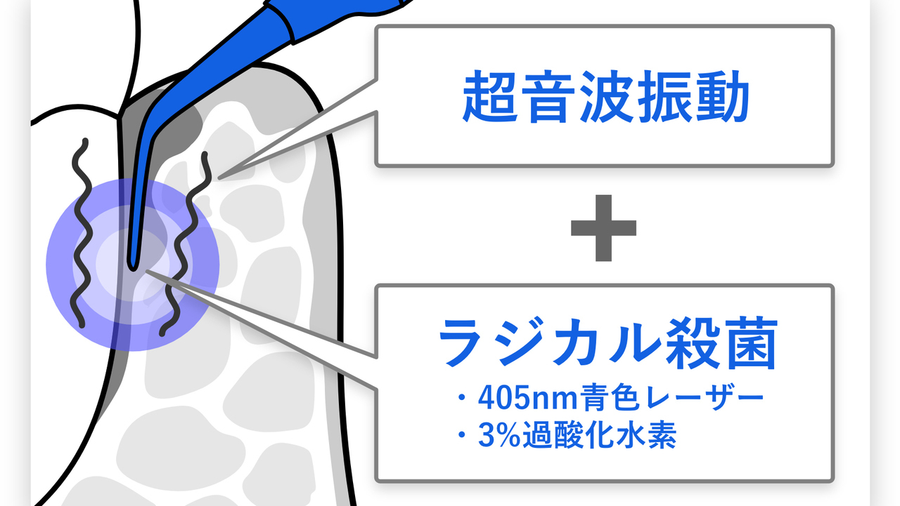 レーザー光で細菌に働くしくみ